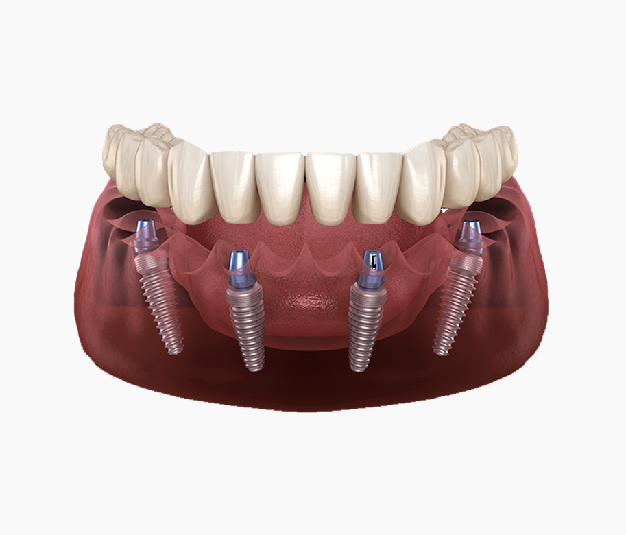 dental implant 1